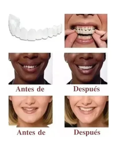 Carillas Dentales Perfecta Sonrisa Smile1
